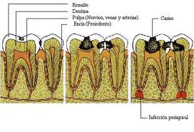 fogszuvasodás, caries